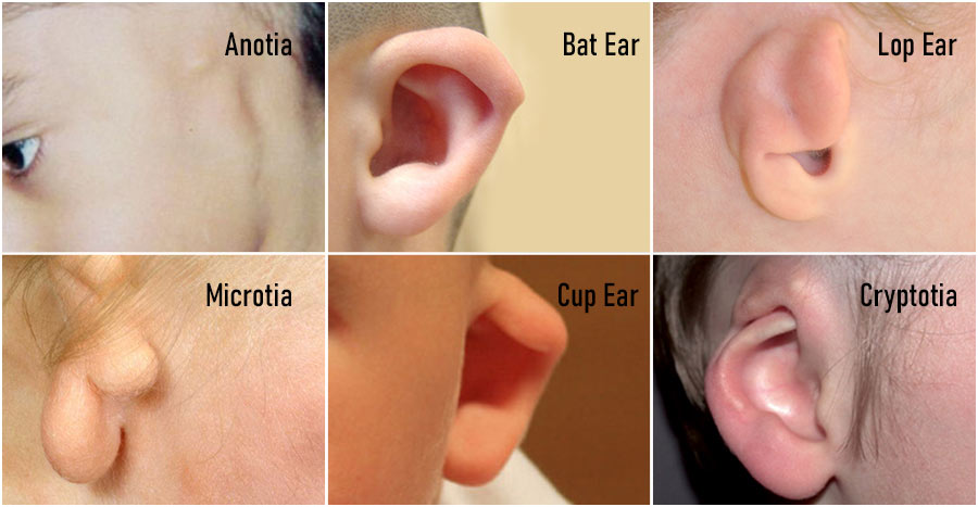 Types Of Ear Deformities And Treatments