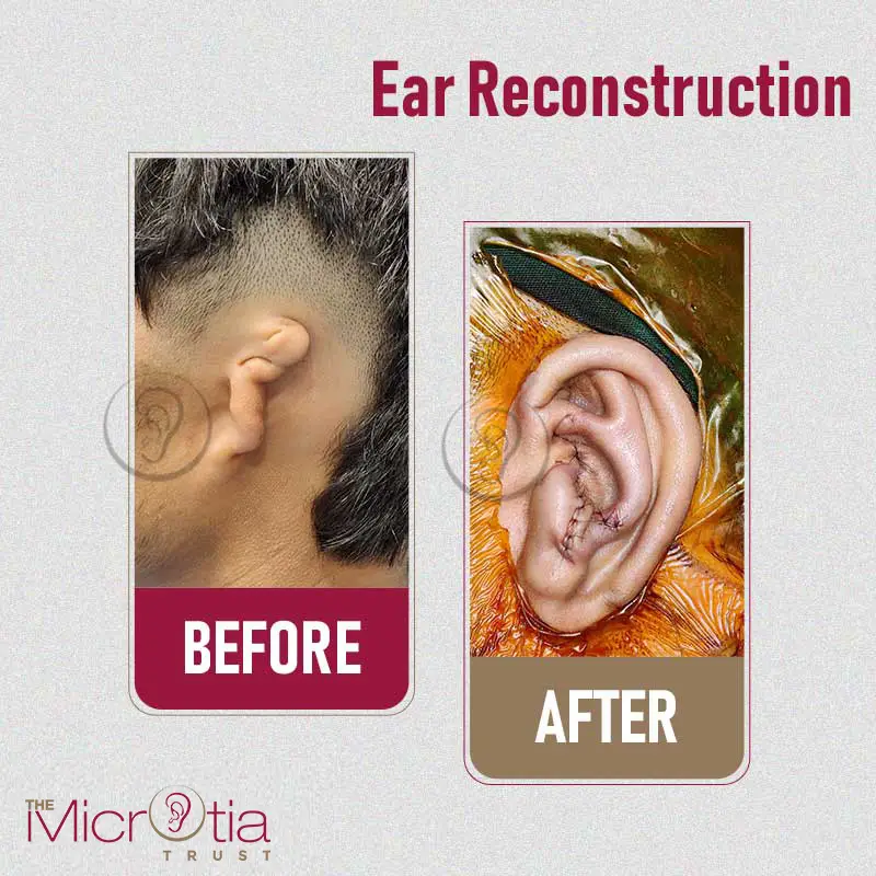 ear reconstruction surgery before and after