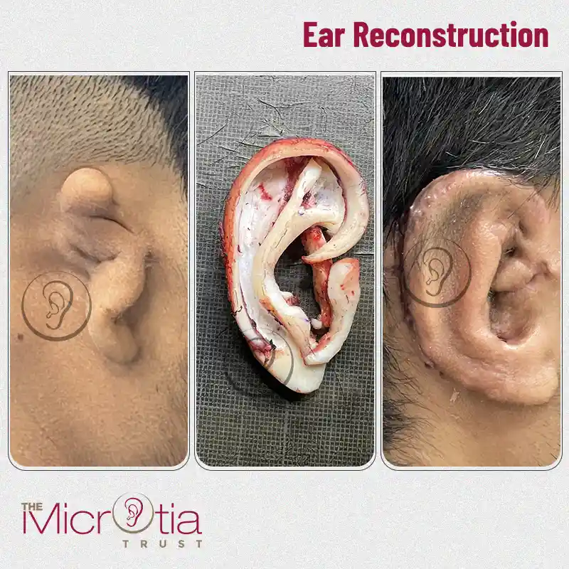 ear reconstruction surgery before and after