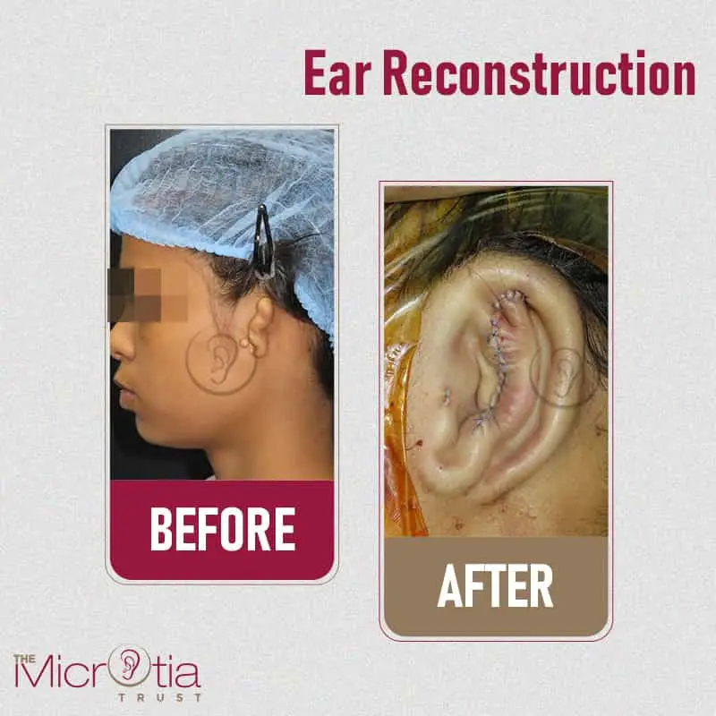 ear reconstruction surgery before and after