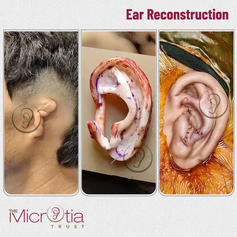 ear reconstruction surgery before and after