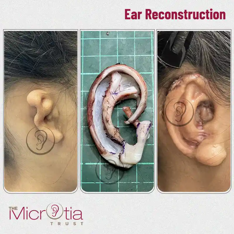 ear reconstruction surgery before and after