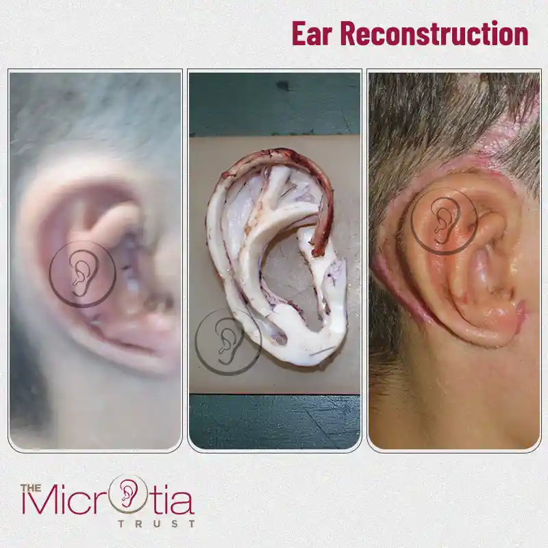 ear reconstruction surgery before and after