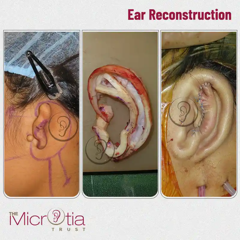 ear reconstruction surgery before and after