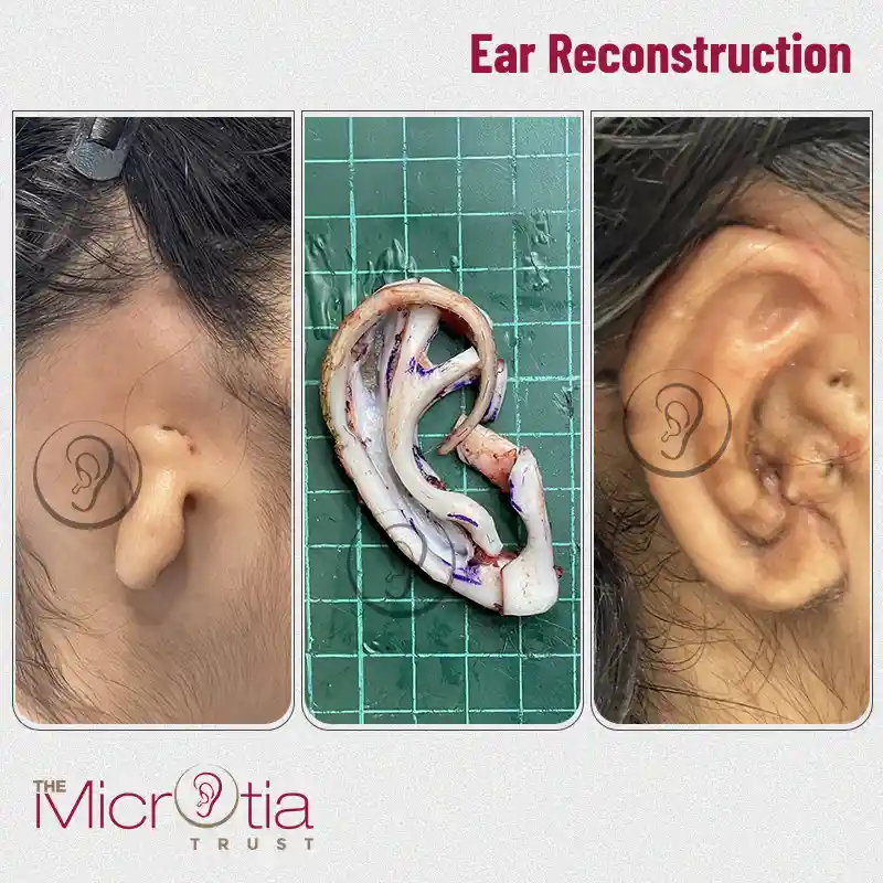 ear reconstruction surgery before and after