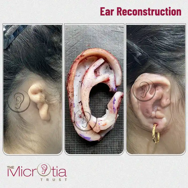 ear reconstruction surgery before and after