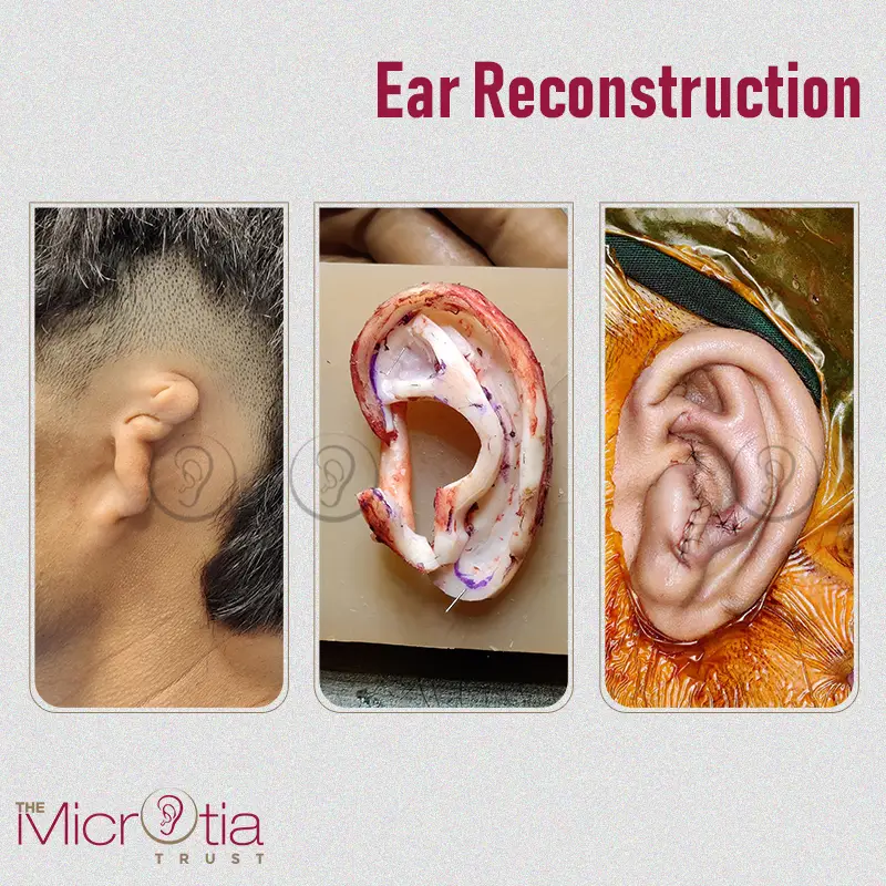 ear reconstruction surgery before and after